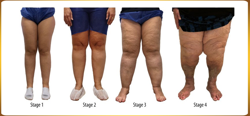 Lipedema