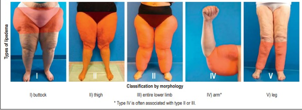 Lipedema